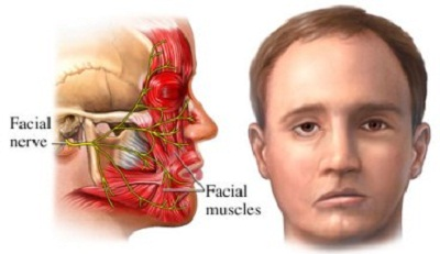 Facial Palsy Image